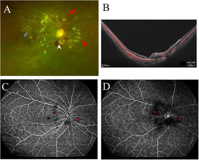 Quantitative assessment of retinal vasculature changes in systemic lupus erythematosus using wide-field OCTA and the correlation with disease activity